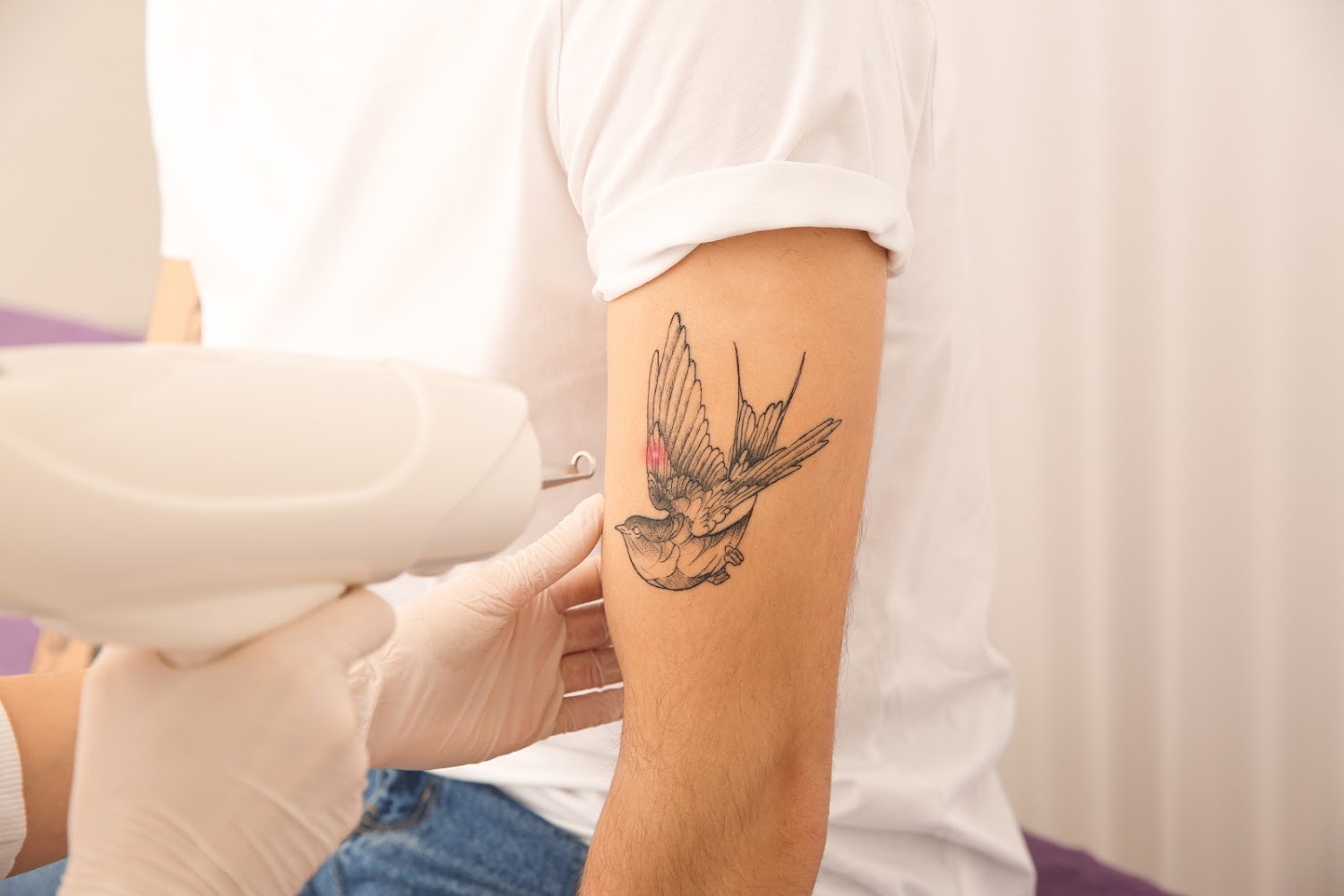Tattoo verwijderen